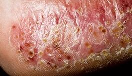 Dermatomycosis