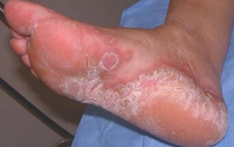 Ostra dermatomycoza stopy