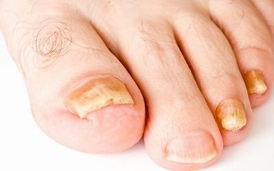 Objawy fotograficzne grzyba paznokci