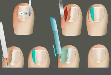 Usuwanie paznokci w obecności grzyba na nogach