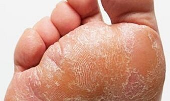 Oznaki i objawy grzyba na nogach