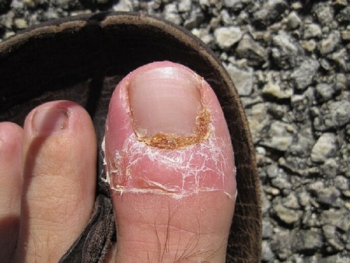 uszkodzenie paznokci i skóry palców u nóg w wyniku infekcji grzybiczej